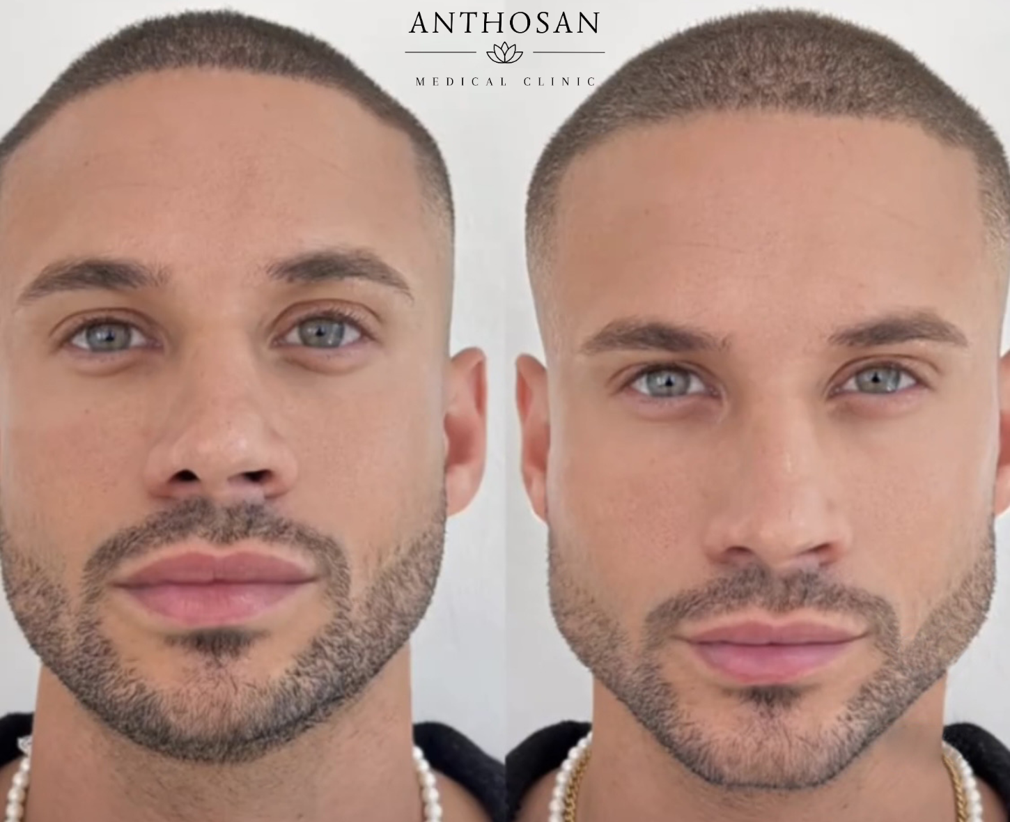 Armonizzazione mento e mandibola